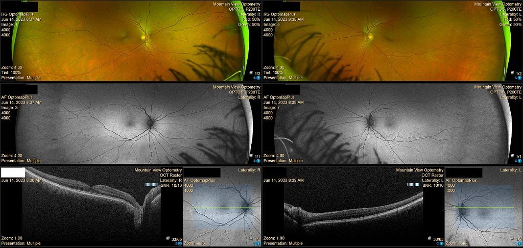 A collage of four different images of a person 's eye
