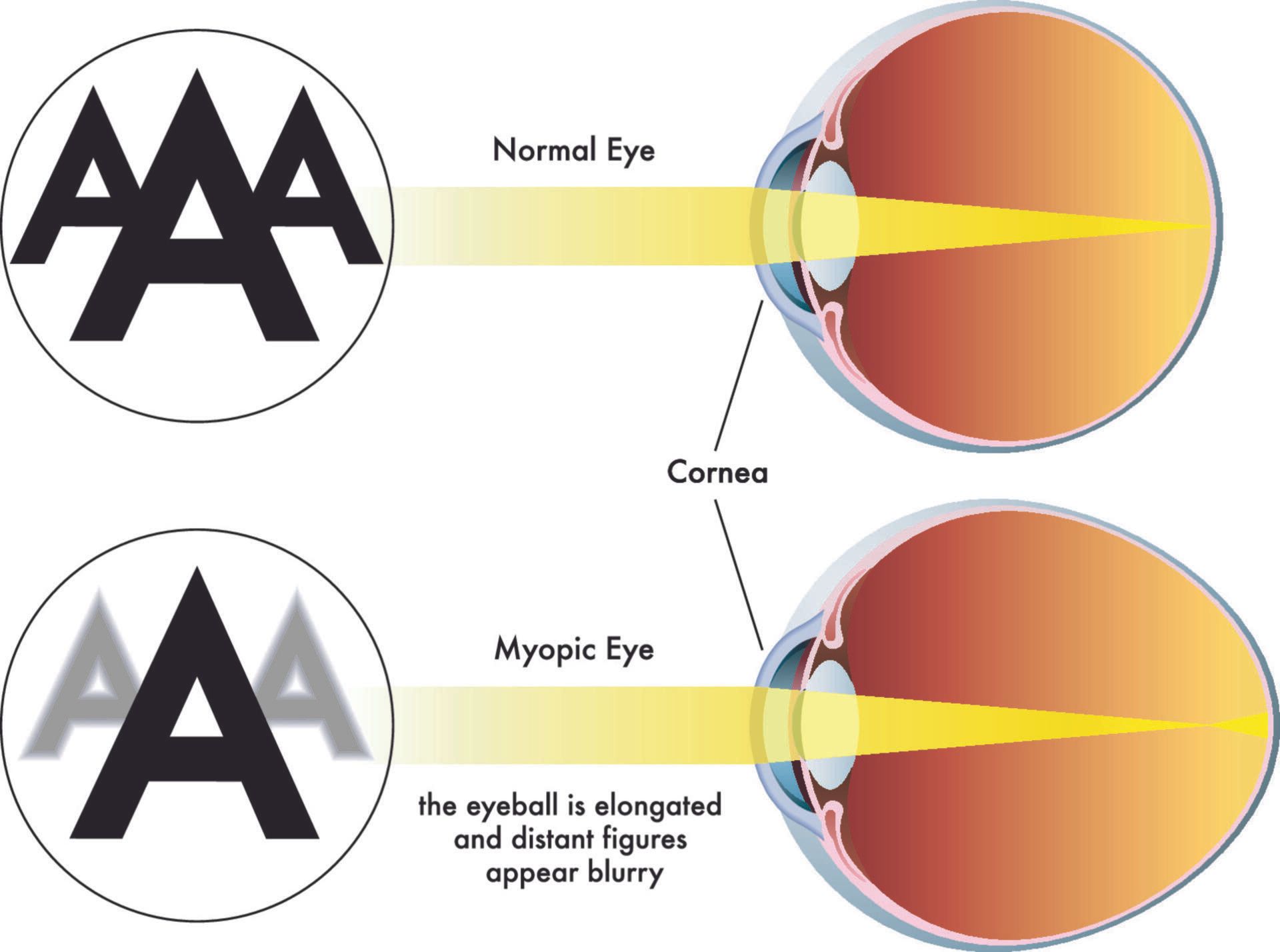 A diagram of a normal eye and a myopic eye