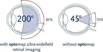 A diagram of a human eye with and without optomap ultra-widefield retinal imaging.