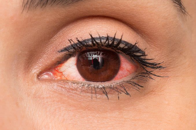A close up of a woman 's red eye with mascara.