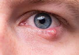 A close up of a man 's eye with a swollen eyelid.