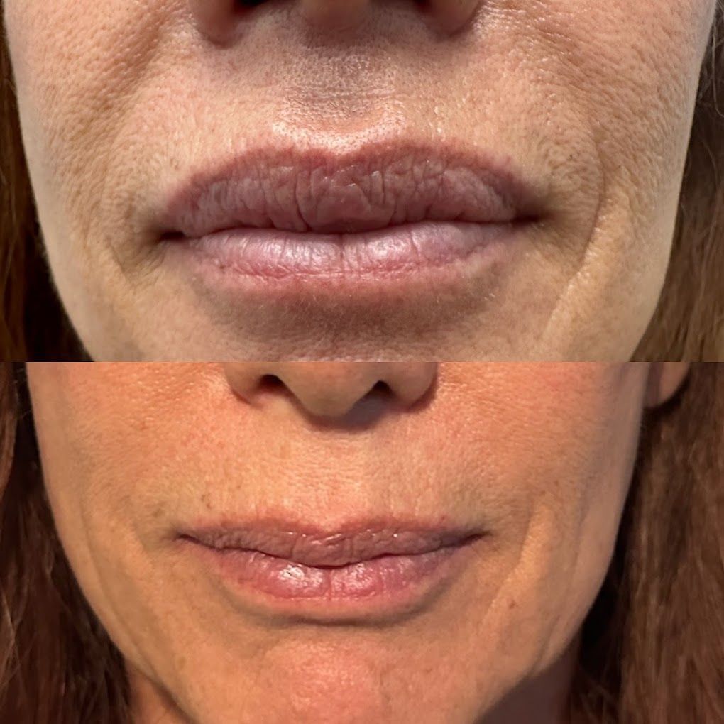 A before and after picture of a woman 's lips.
