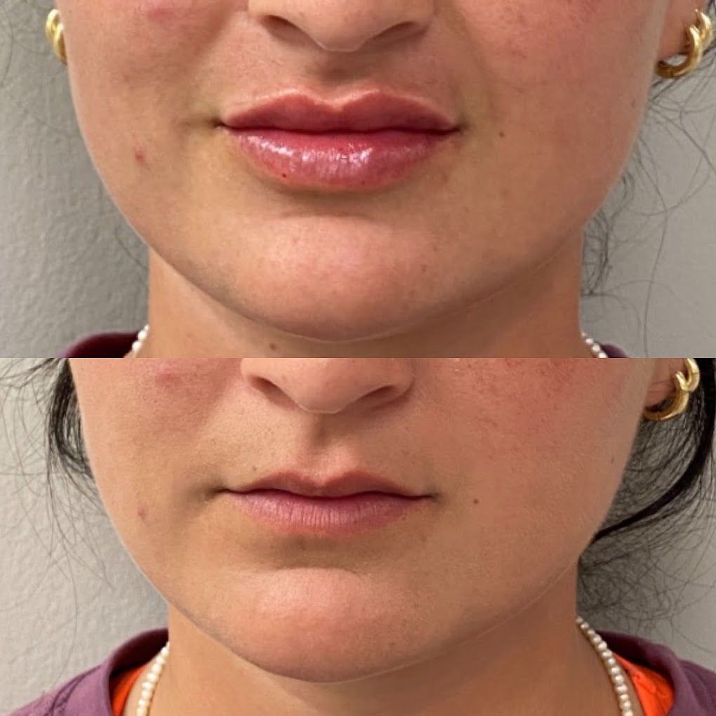 A before and after photo of a woman 's lips.