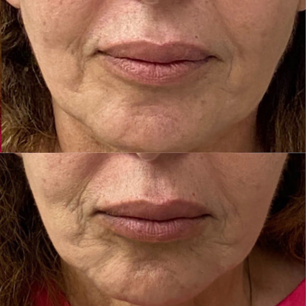A before and after photo of a woman 's lips.