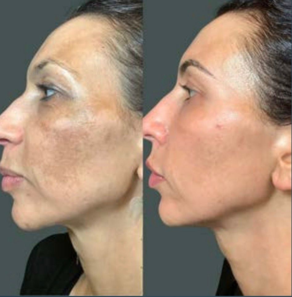Before and after comparison of a person's facial skin with brown spots, showing improvement after treatment.