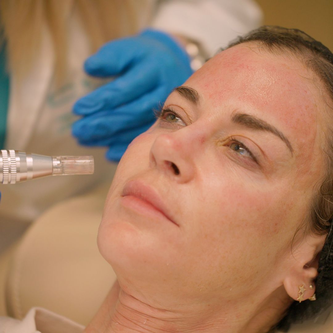 Woman receiving microneedling treatment on her face; red skin visible; medical professional wearing gloves.