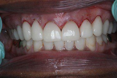 Performing Crown After — High Point, NC — High Point Smile Dentistry Dr. Paul Kwon and Associates