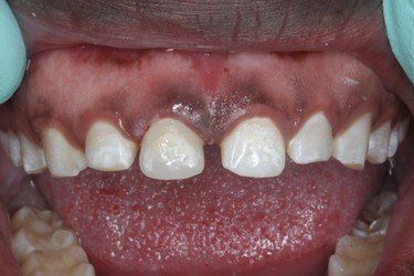 Broken Teeth After — High Point, NC — High Point Smile Dentistry Dr. Paul Kwon and Associates