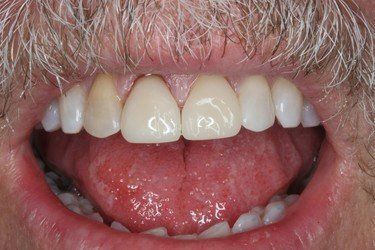 Mouth open, showing teeth. Front two teeth are lighter than others; one has a dark spot.