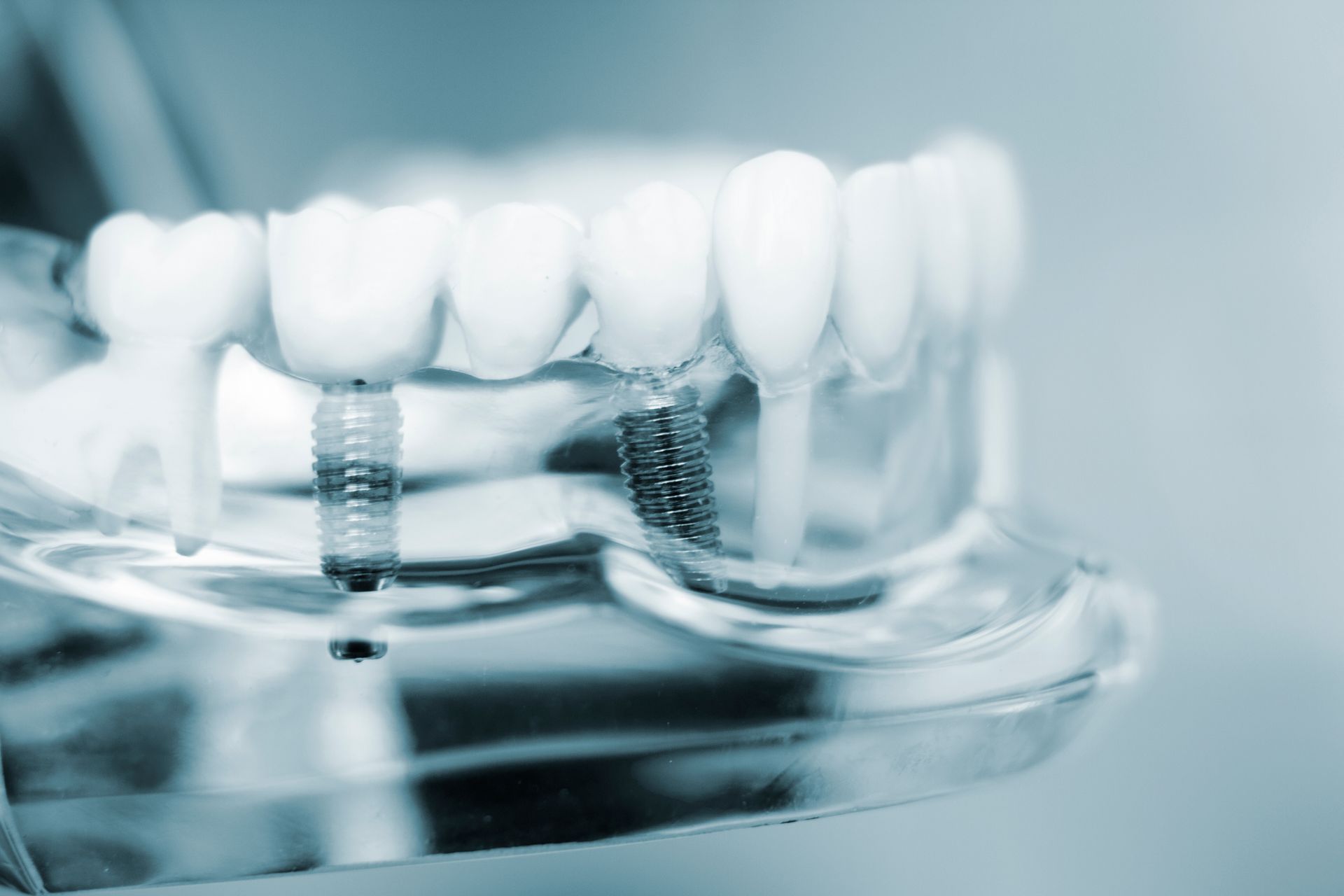 A dental model showing artificial teeth attached to metal implants in a clear jaw demonstration. A dental model showing artificial teeth attached to metal implants in a clear jaw demonstration.