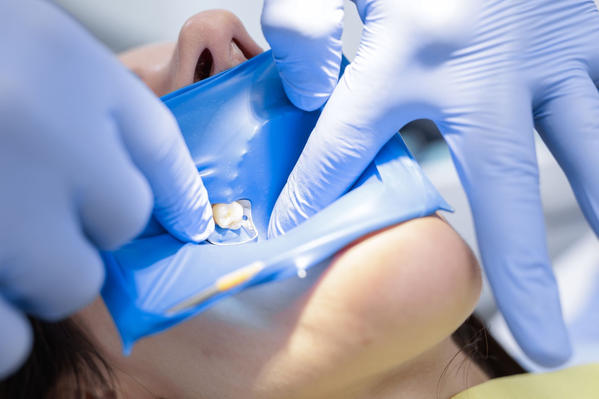 Dental professional placing a dental dam around a tooth to isolate the treatment area.
