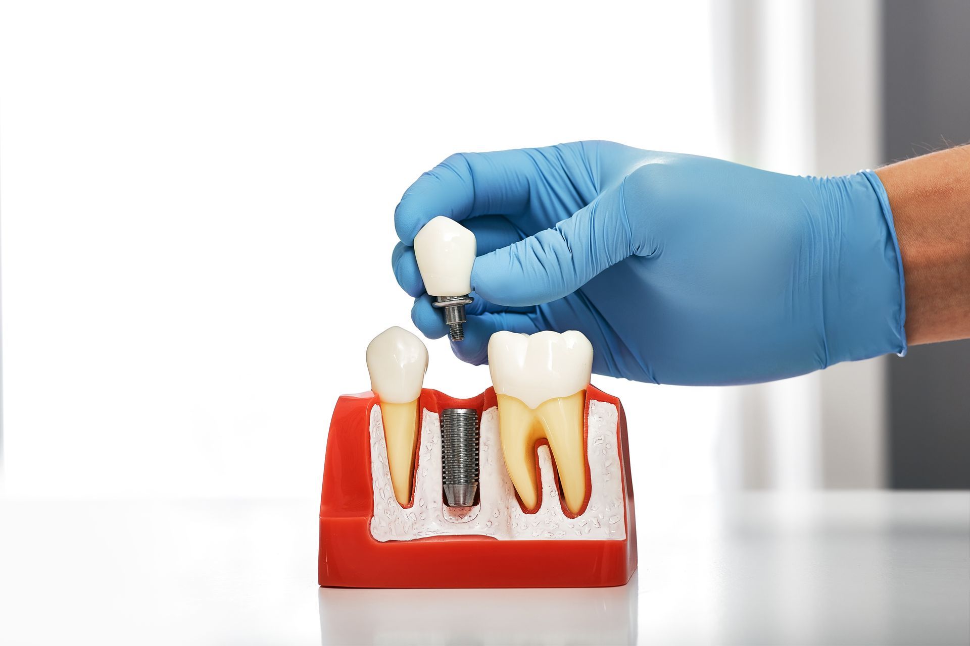 A dental professional inspecting a tooth for a root canal. A dental professional inspecting a tooth for a root canal.