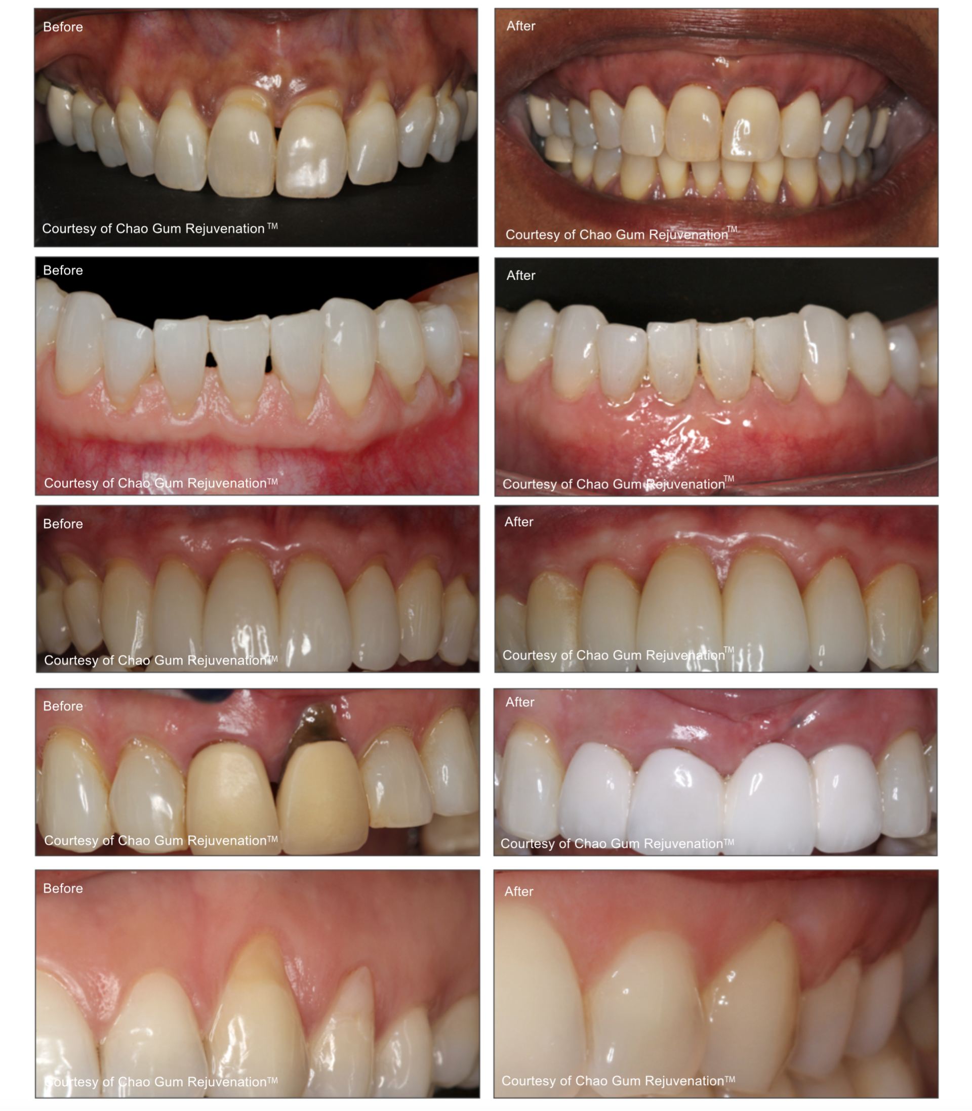 Before And After PST — High Point, NC — High Point Smile Dentistry Dr. Paul Kwon and Associates Before And After PST — High Point, NC — High Point Smile Dentistry Dr. Paul Kwon and Associates