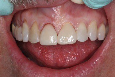 Without Chipped — High Point, NC — High Point Smile Dentistry Dr. Paul Kwon and Associates