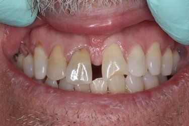 Close-up of a person's teeth, showing chipped front teeth, yellowing, and a gap between the two front teeth.