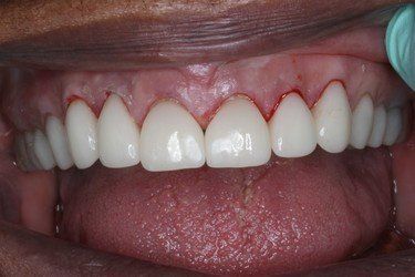 Without Crown After — High Point, NC — High Point Smile Dentistry Dr. Paul Kwon and Associates