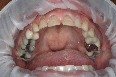 Without Crown Before — High Point, NC — High Point Smile Dentistry Dr. Paul Kwon and Associates