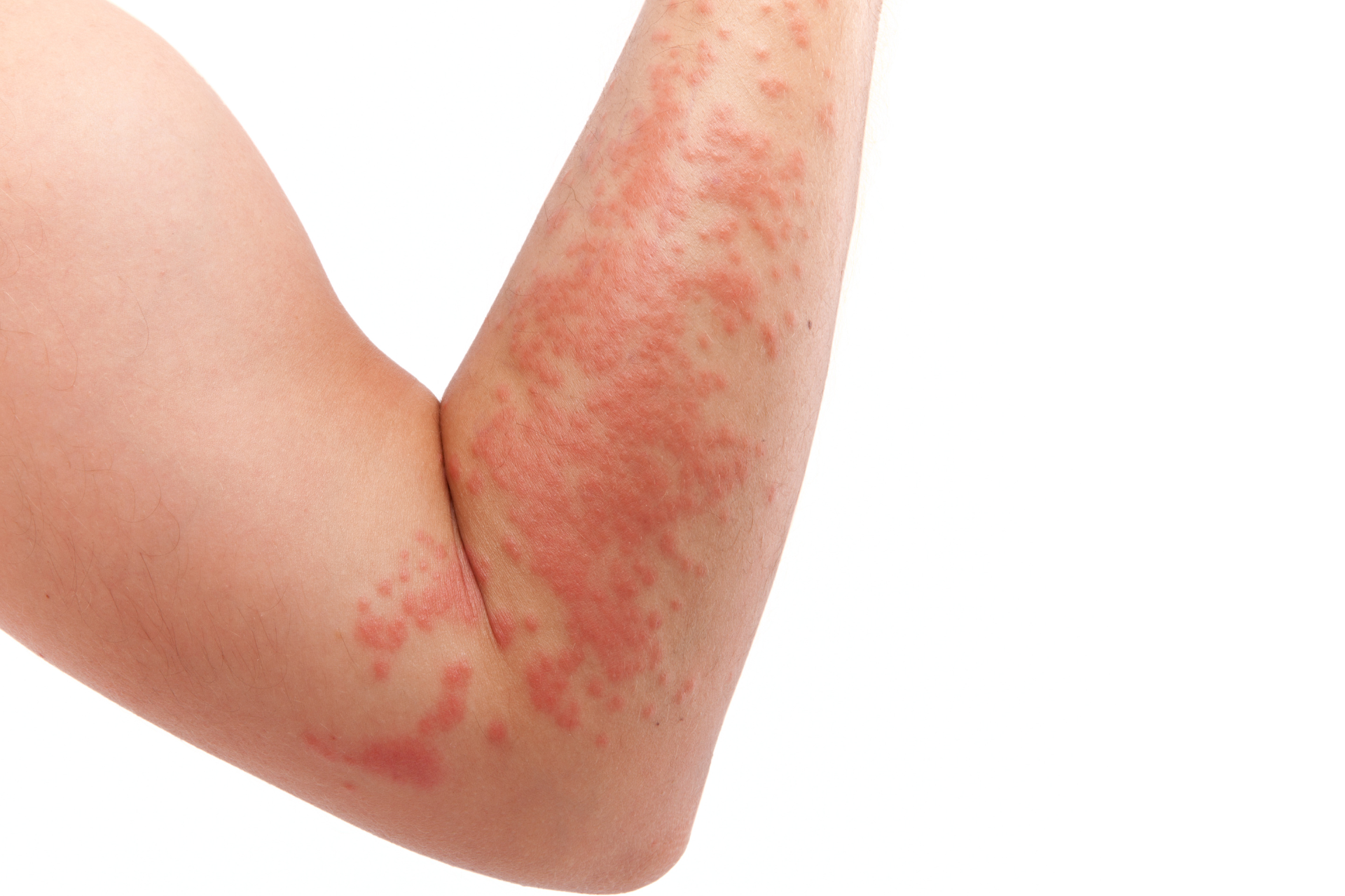 How to Identify and Treat Common Skin Allergies, image size:1920x1280