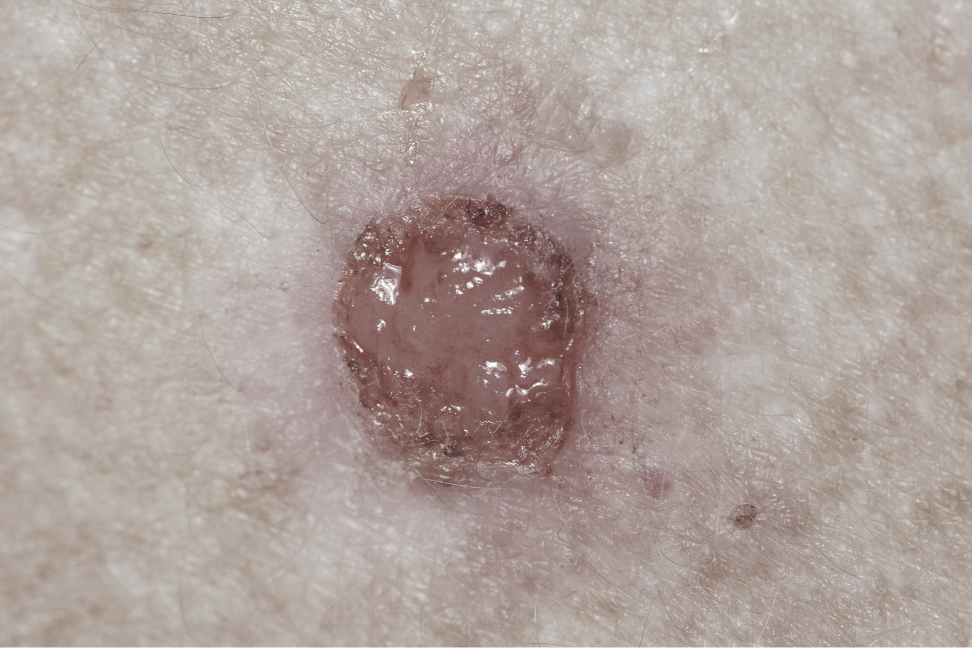 A close up of skin cancer