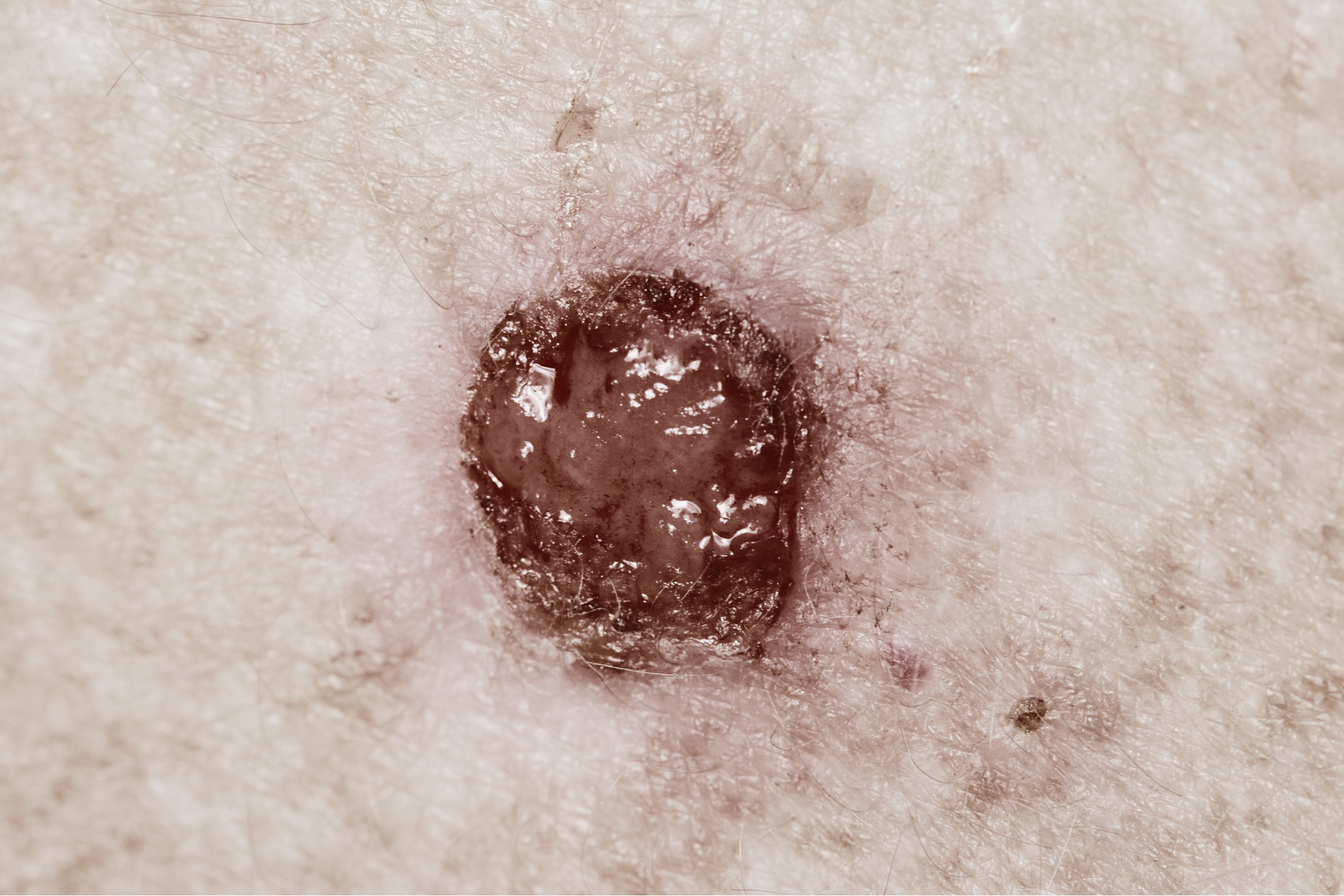 skin cancer