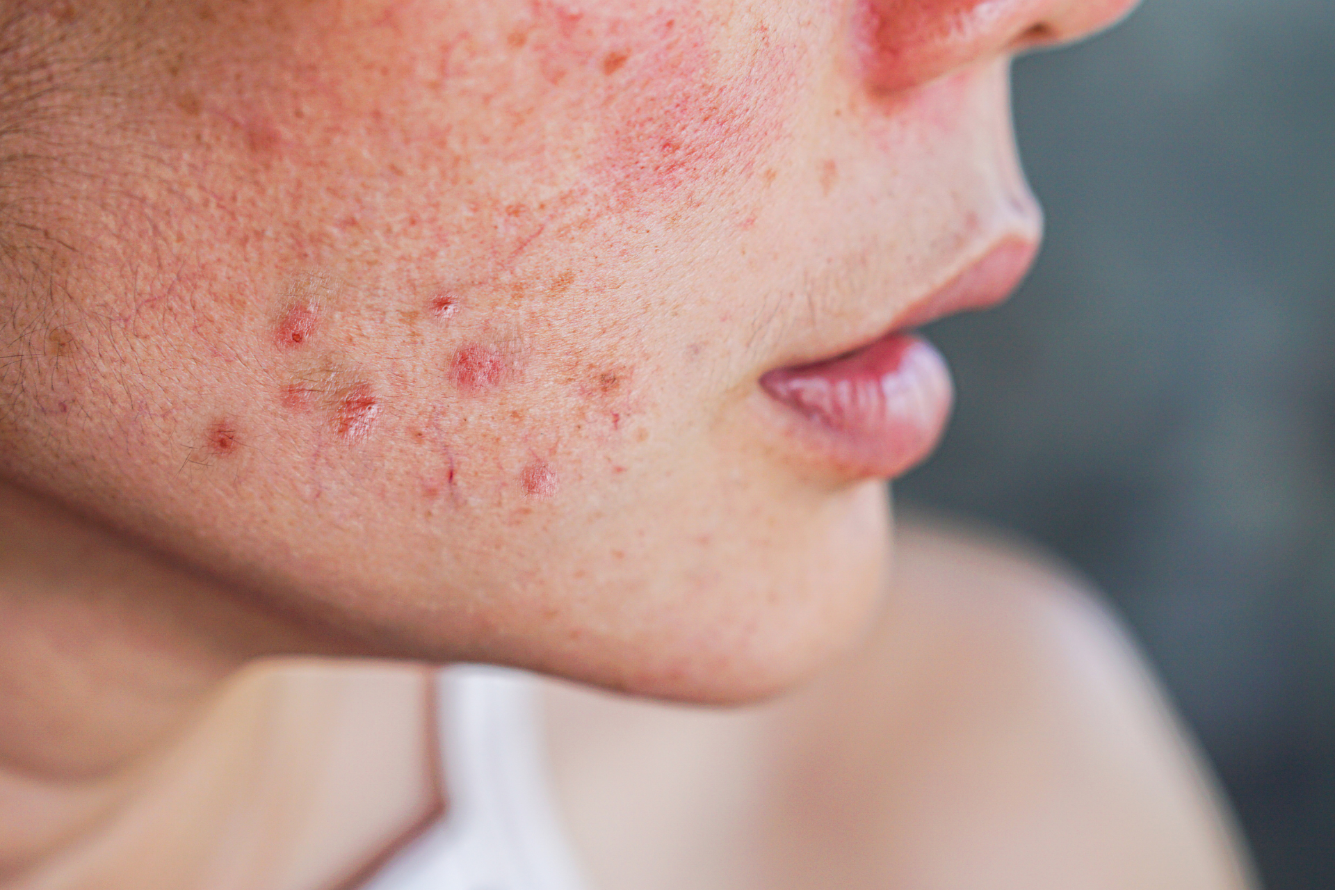 Acne