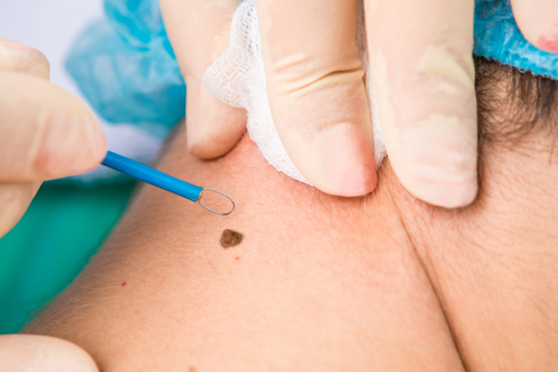 Mole Removal
