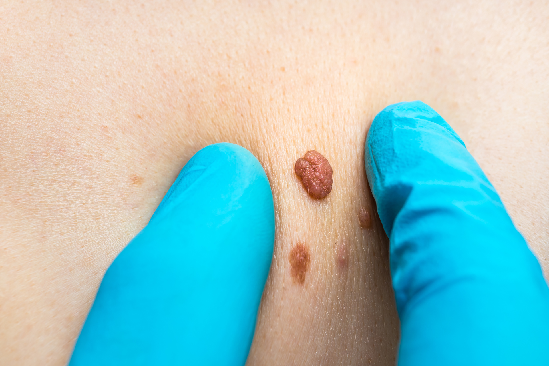 Skin Tags