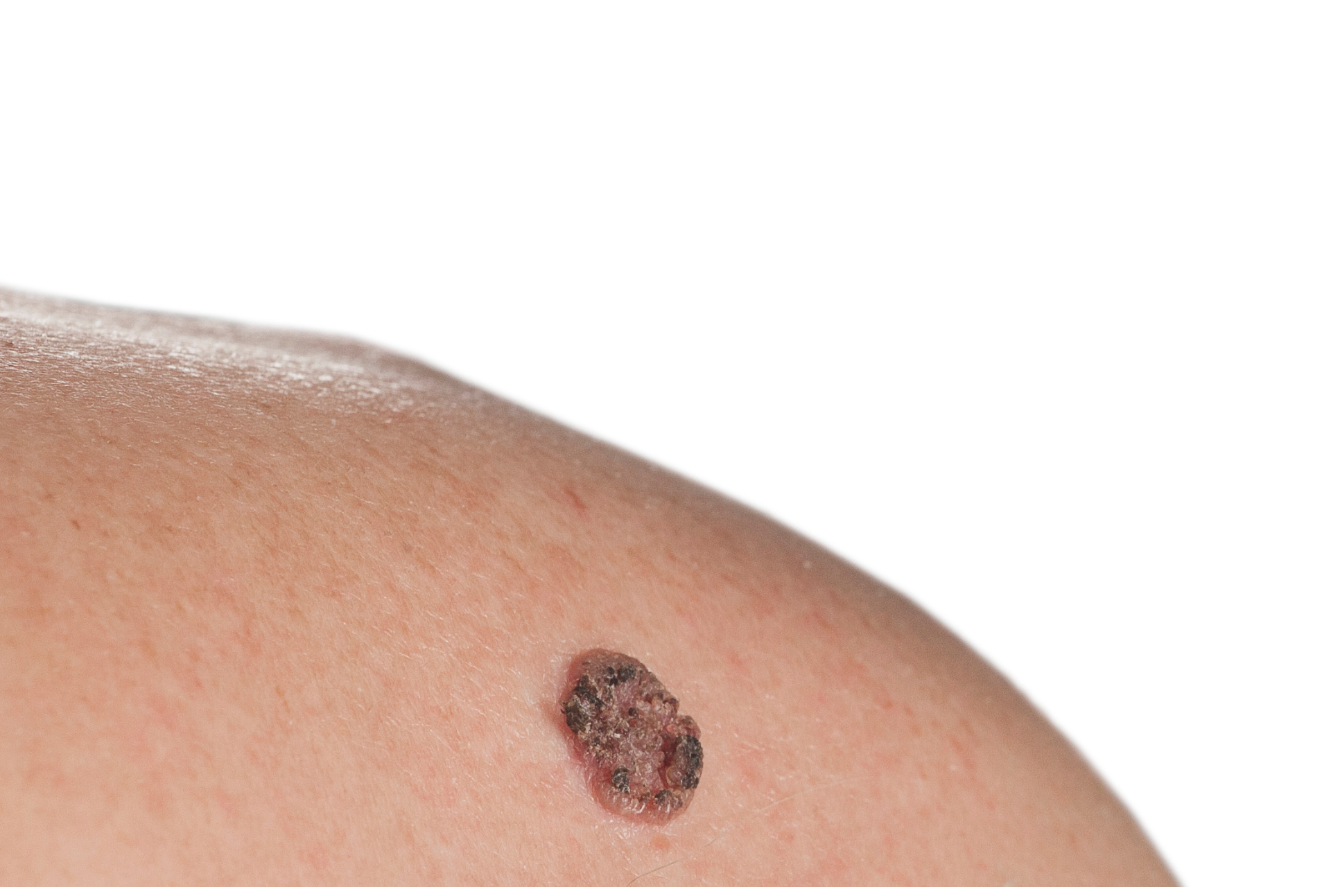 Skin Cancer