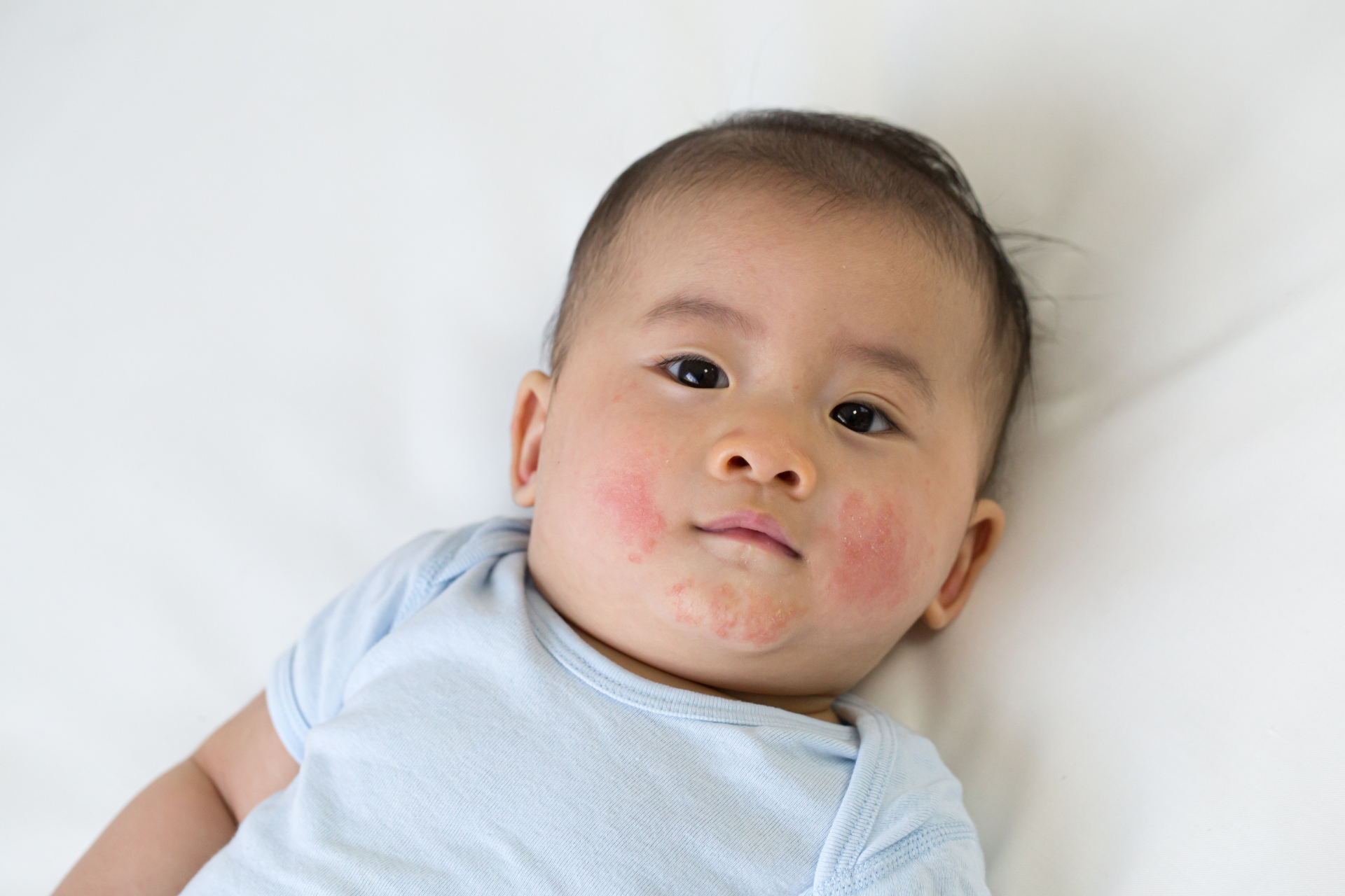 Skin Conditions in Children