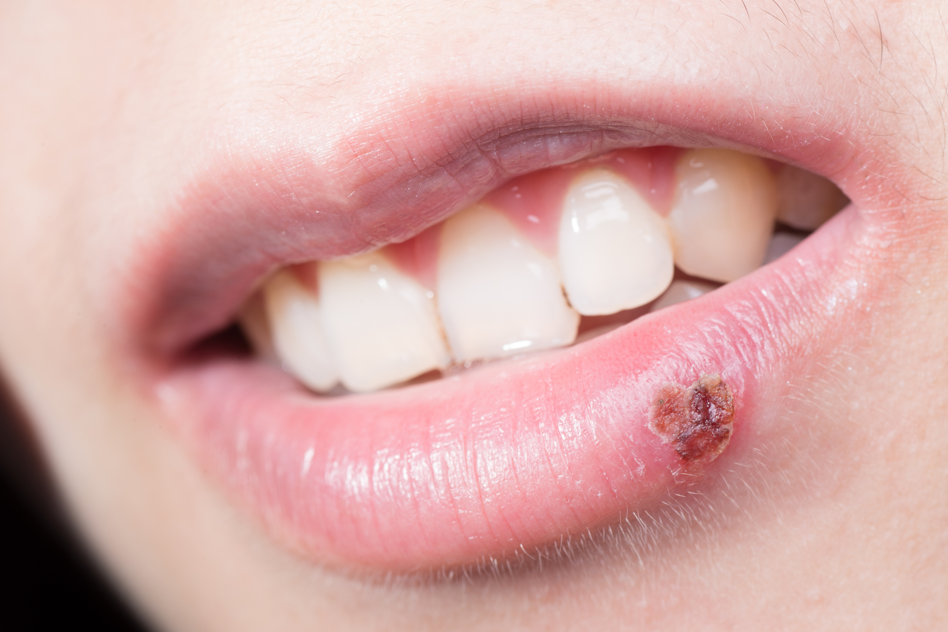 Cold Sores
