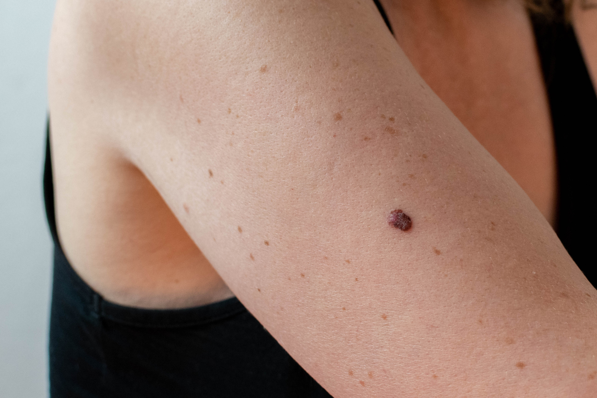 Early Signs of Skin Cancer