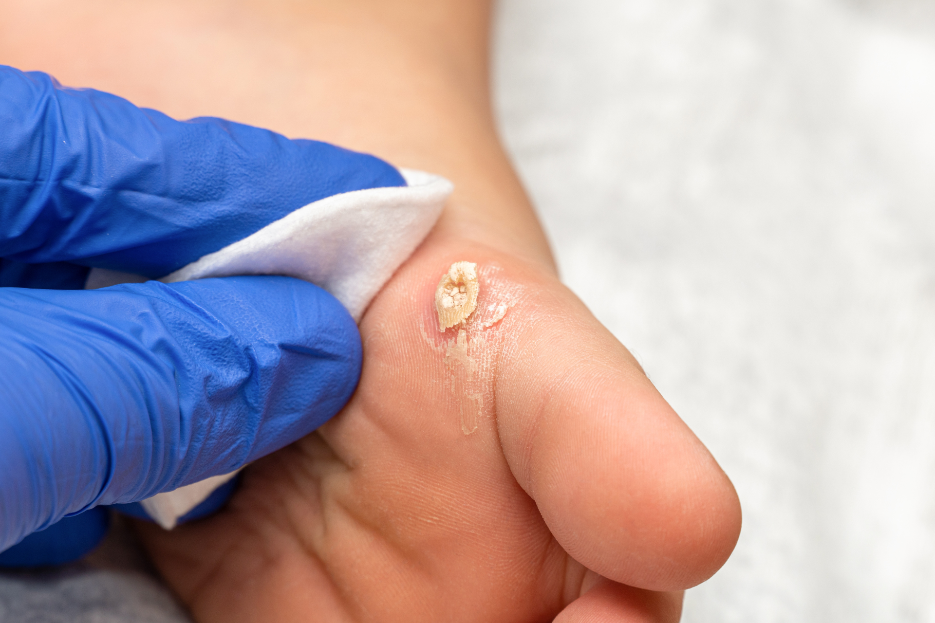 Treatments for Warts