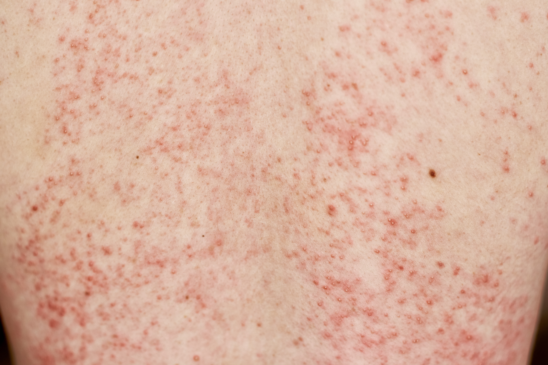 Skin Rashes