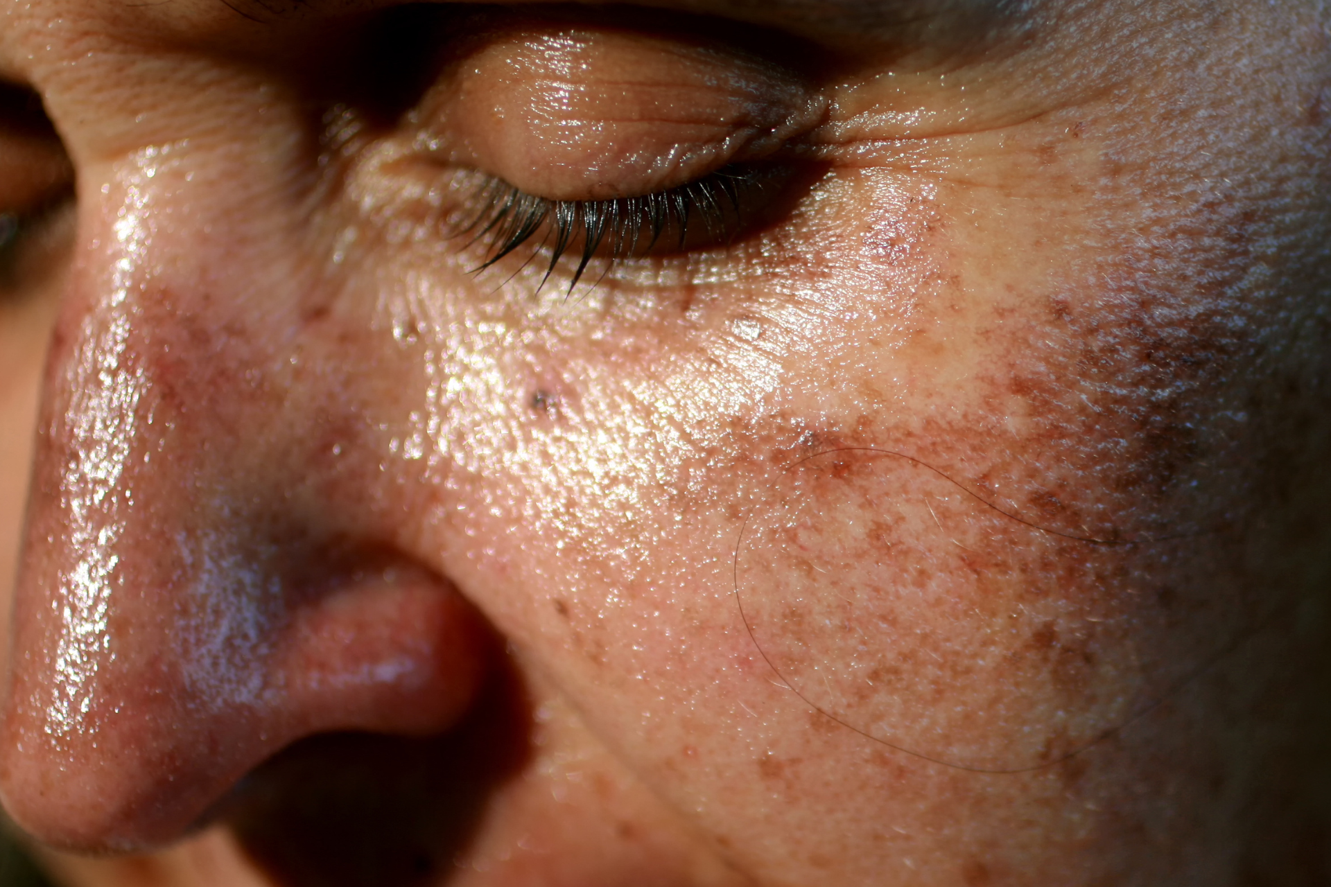 Age Spots