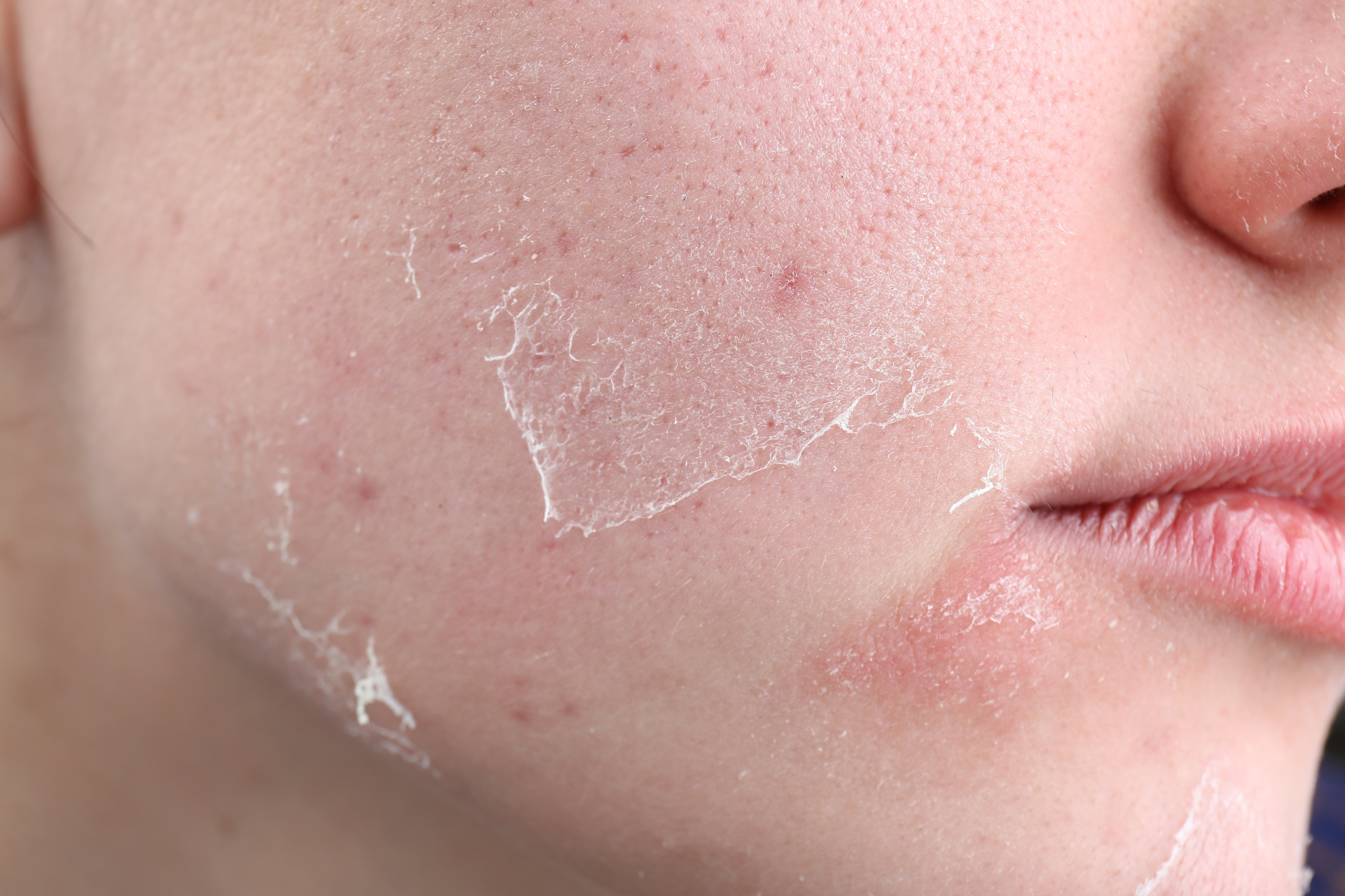 Dry & Dehydrated Skin