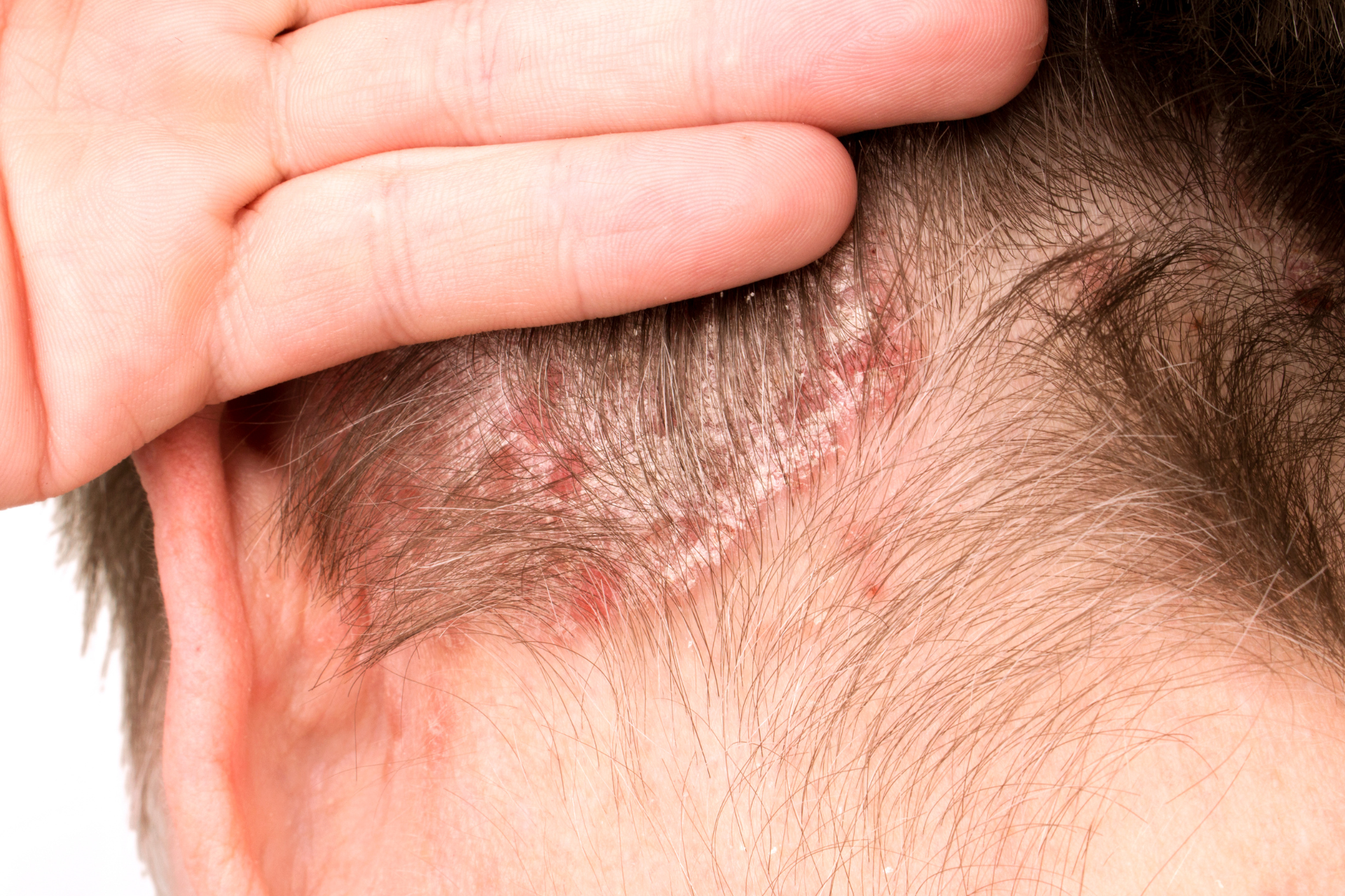 Psoriasis