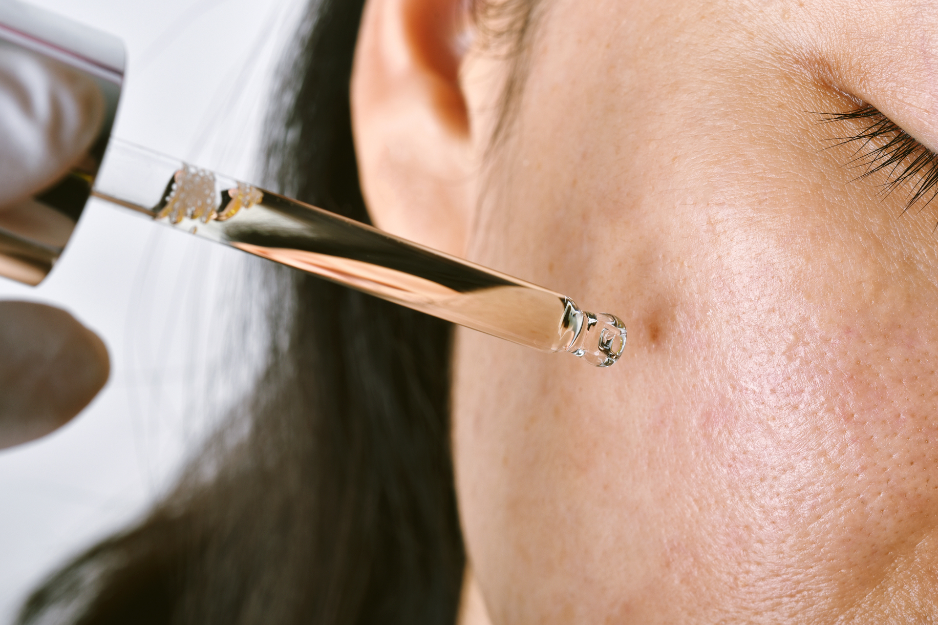 Acne Treatment
