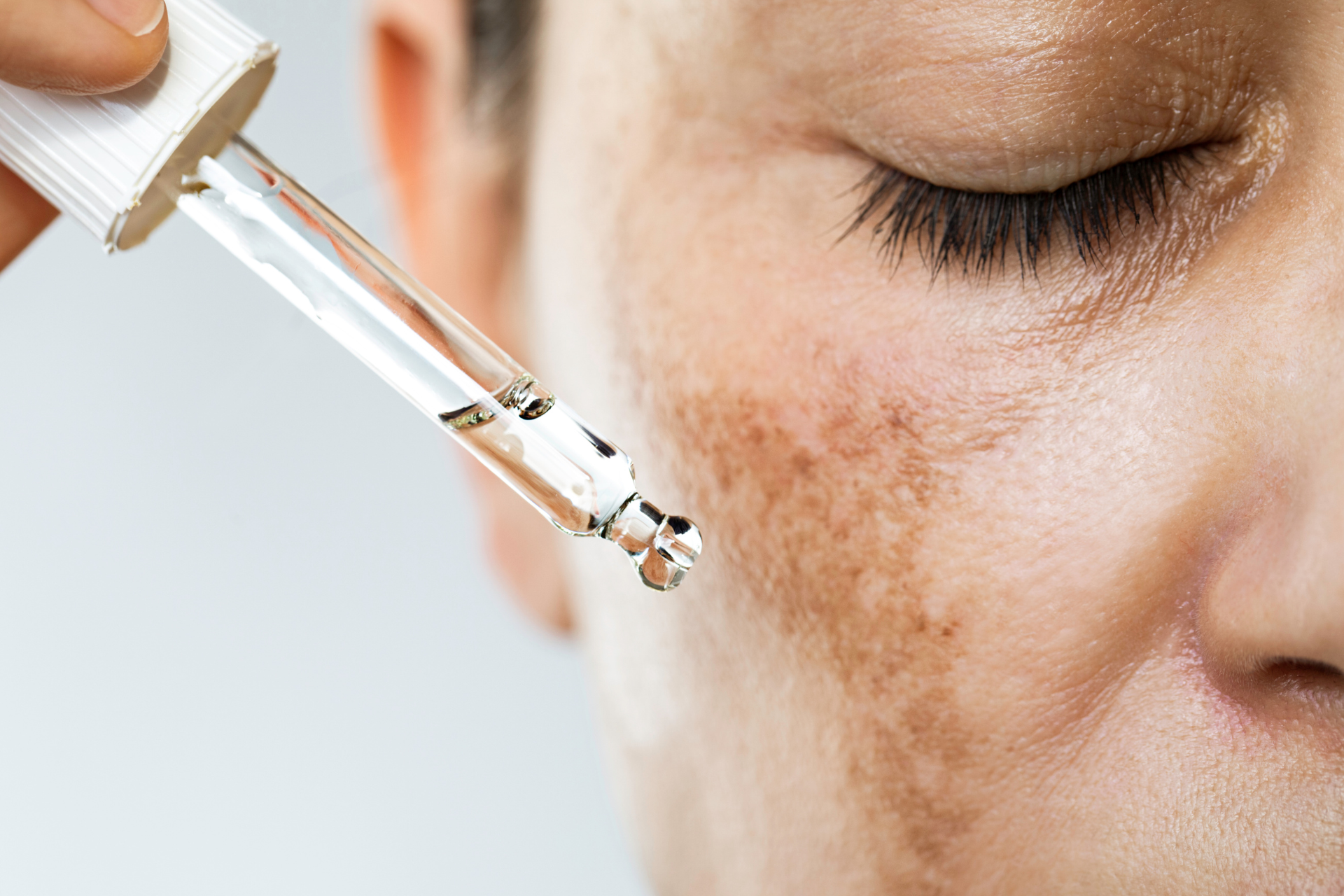 Hyperpigmentation