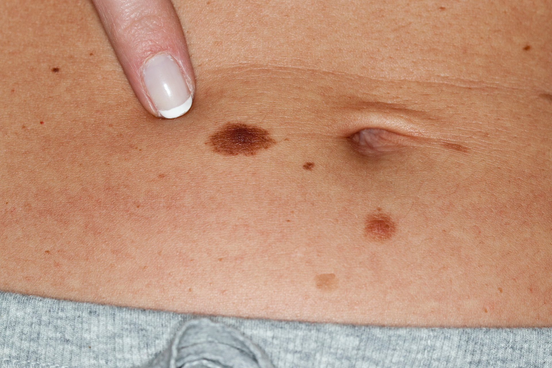 Skin Cancer