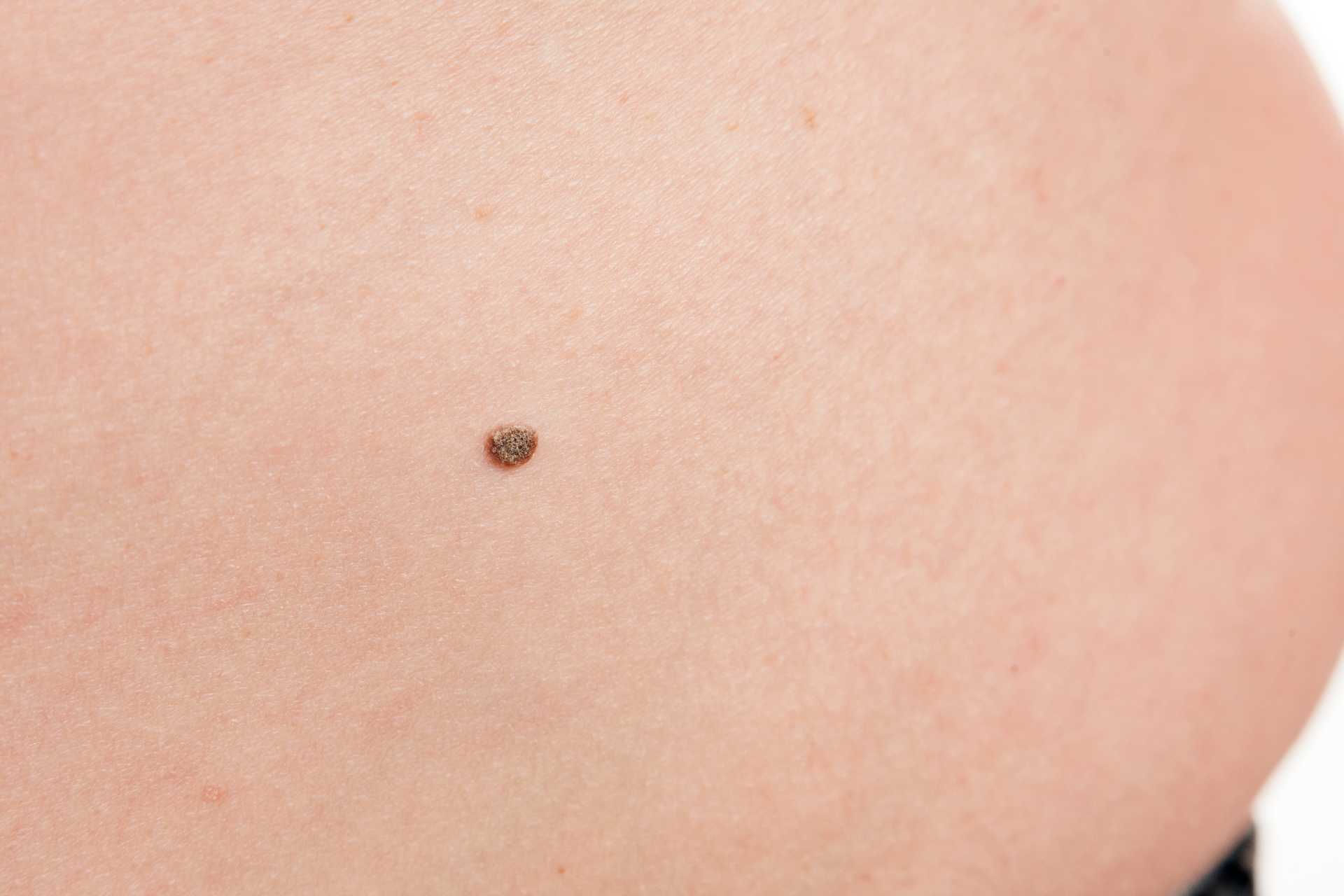 Skin Cancer