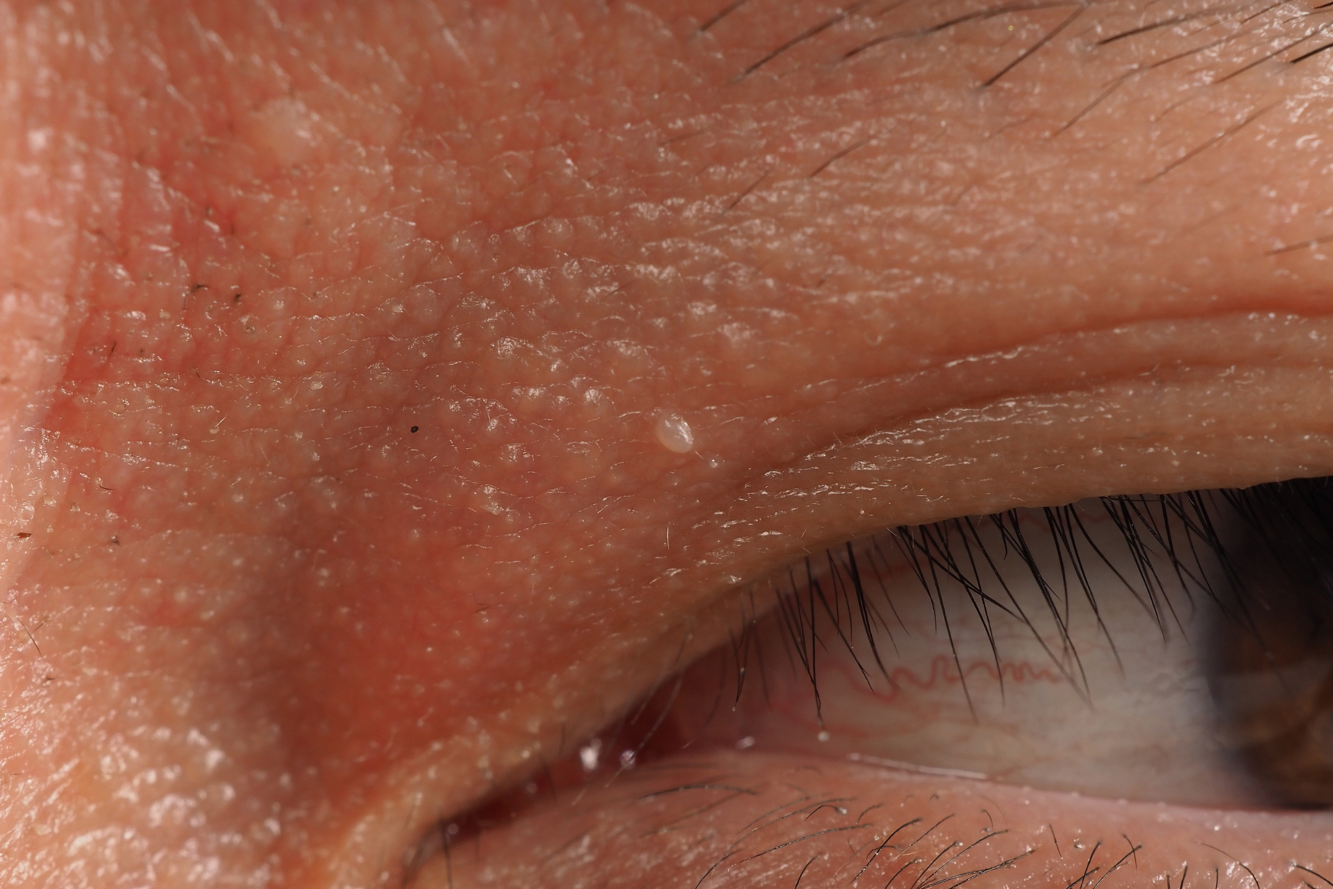 Warts Near the Eyes