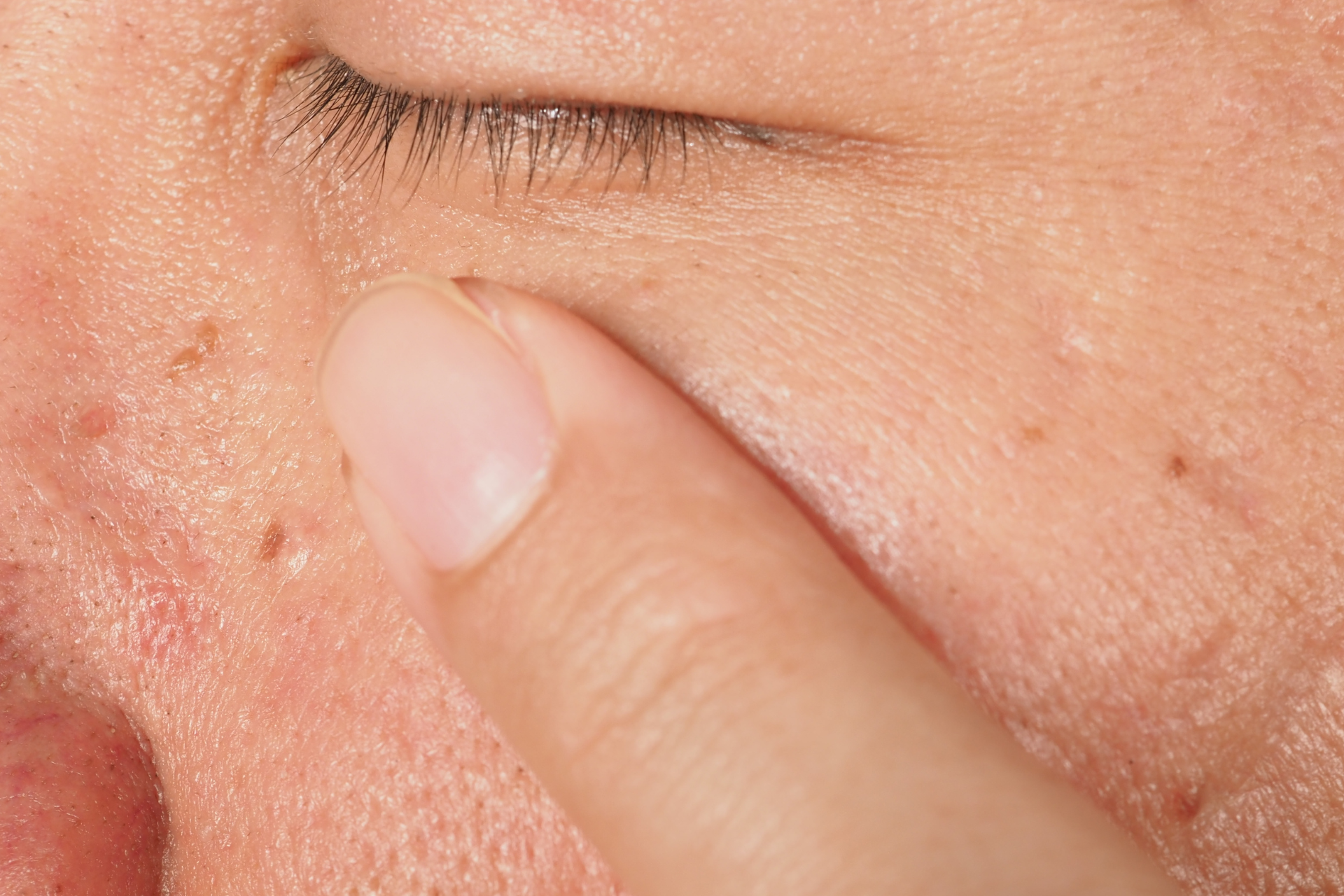 Warts