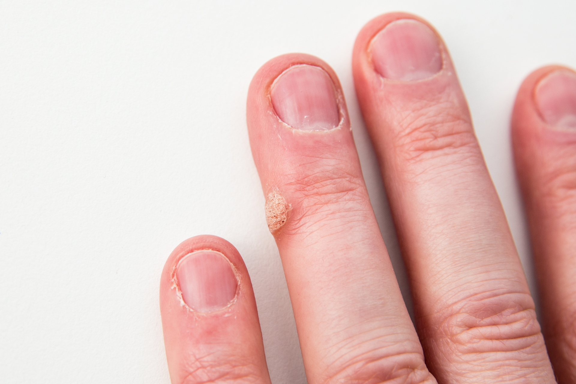 Wart on the Finger