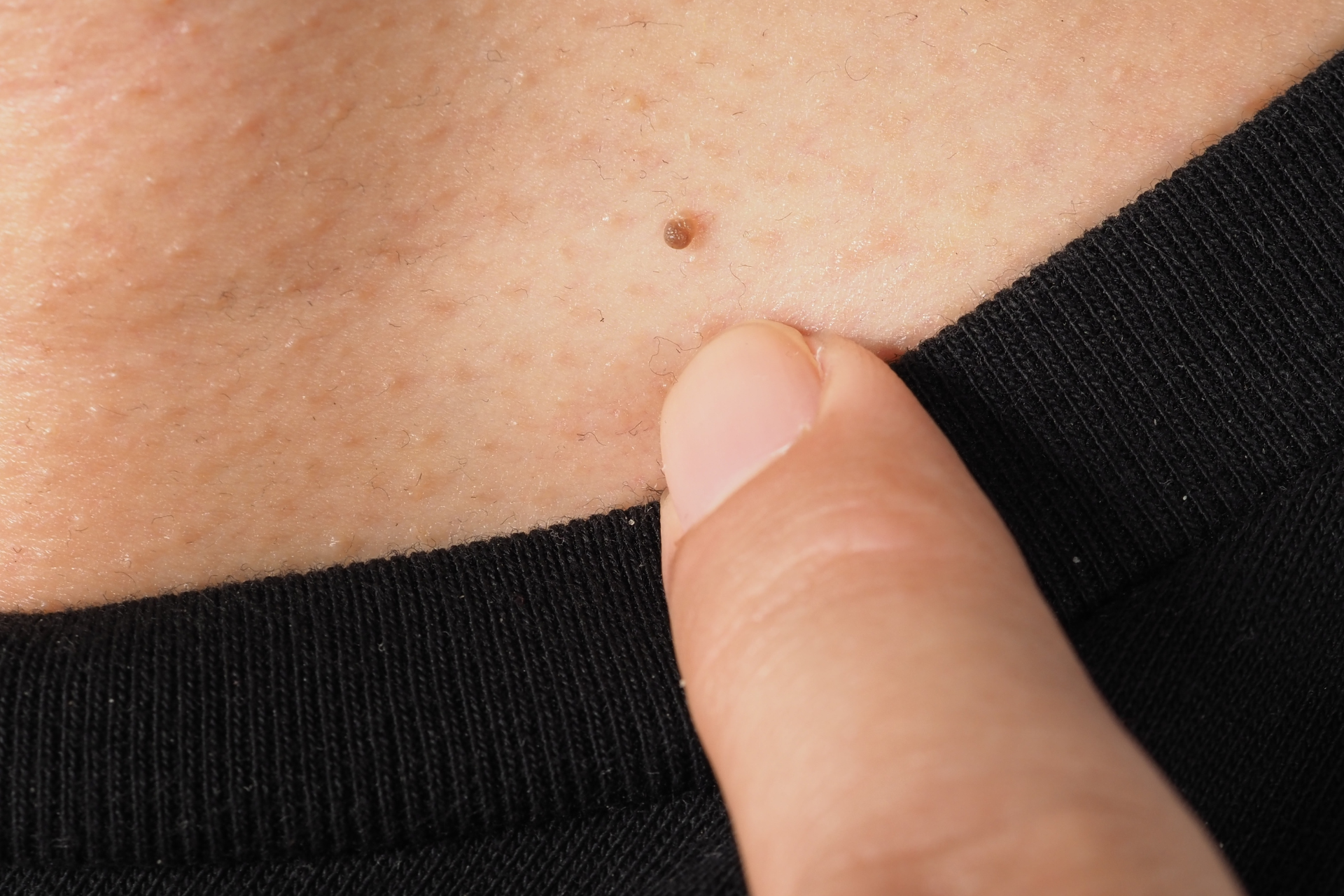 Wart