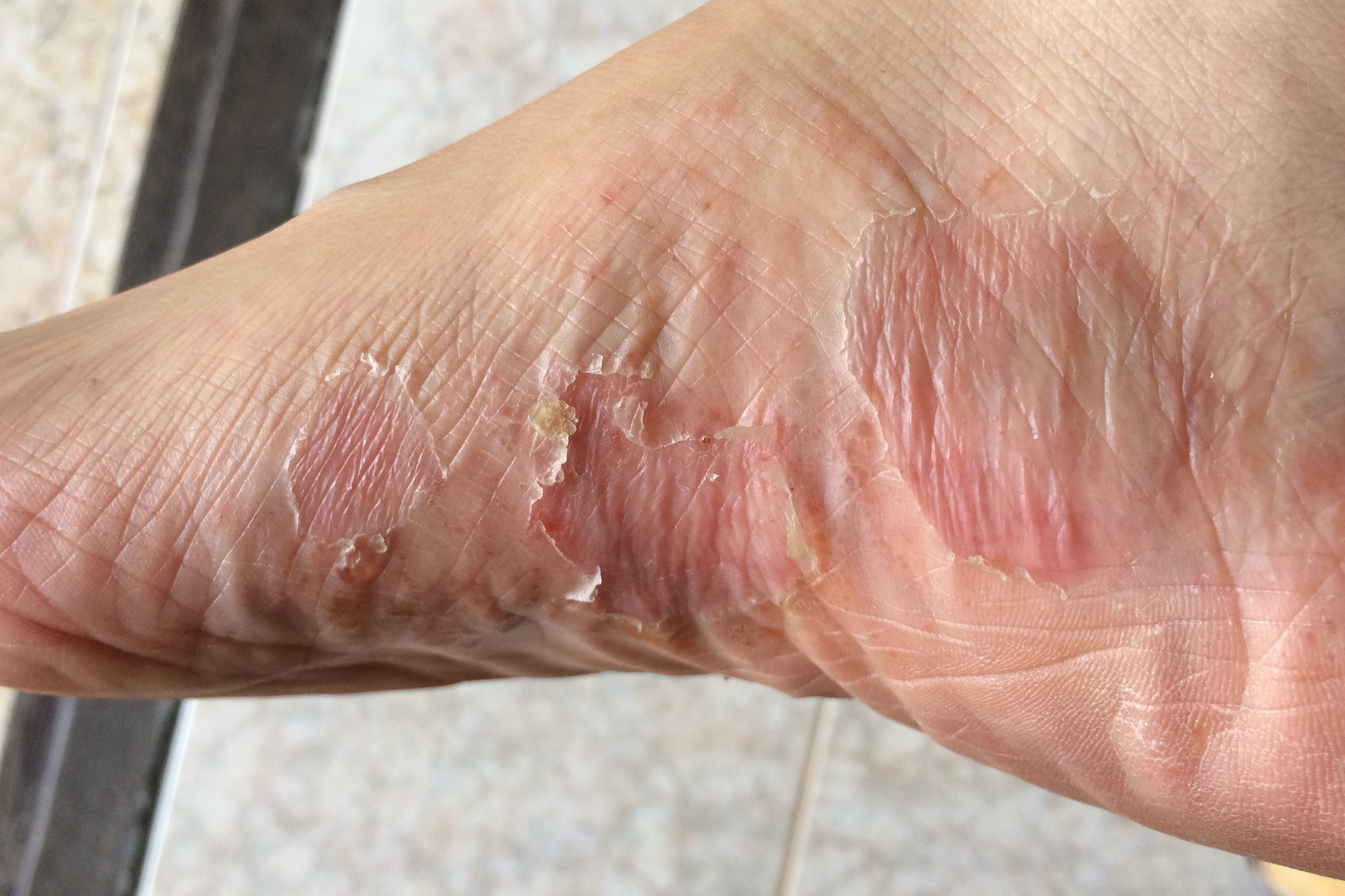 Skin Infection