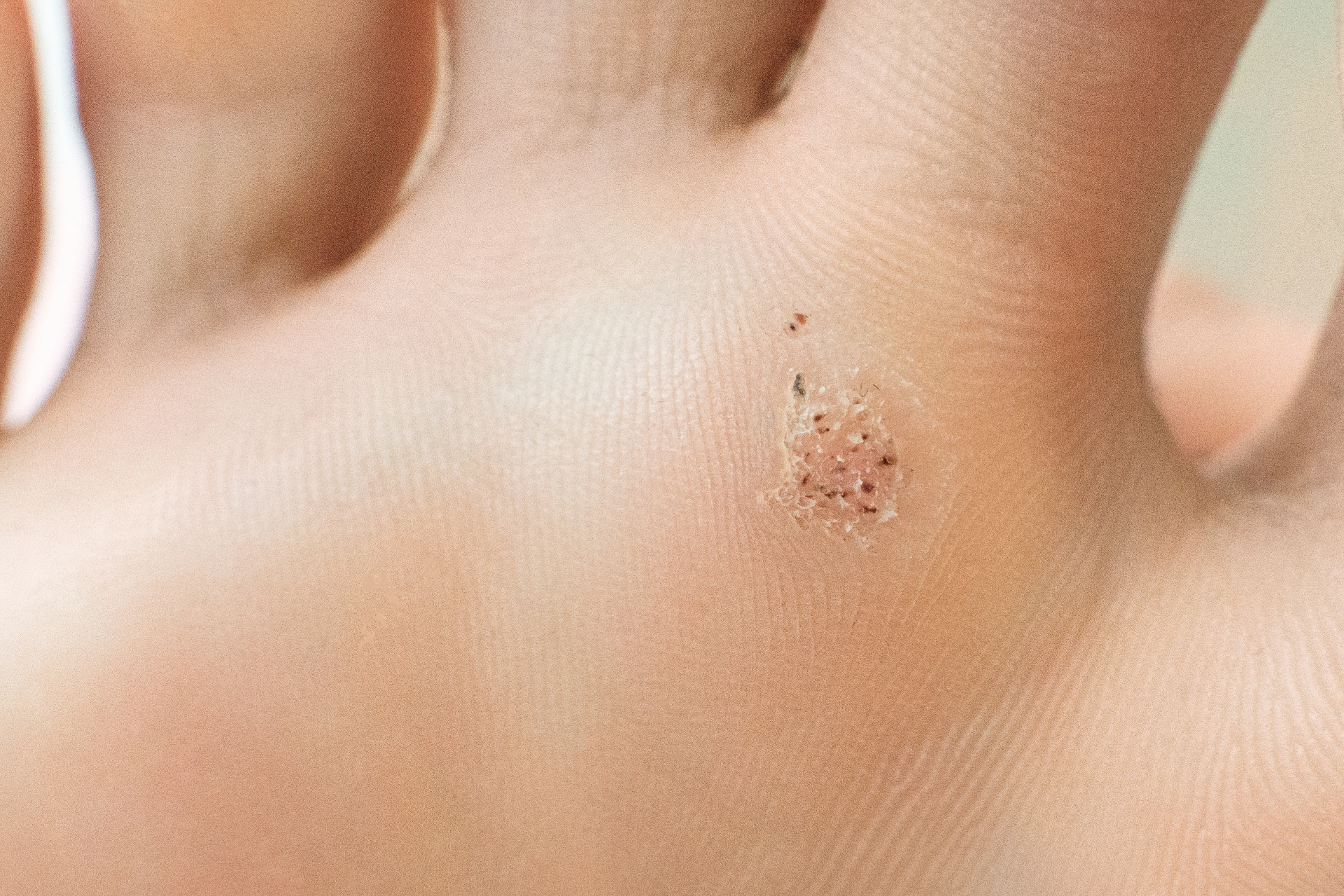 Wart