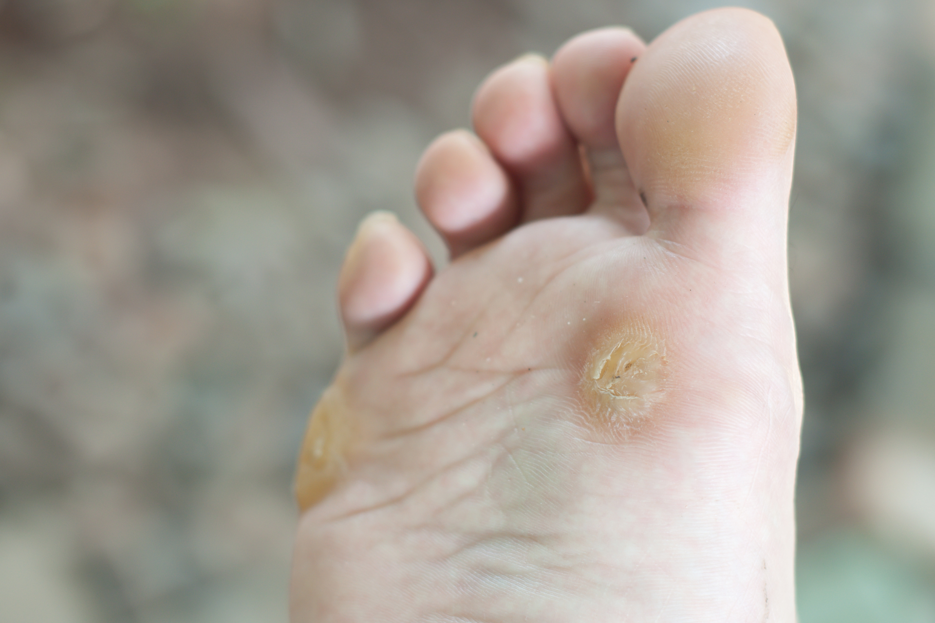 Warts