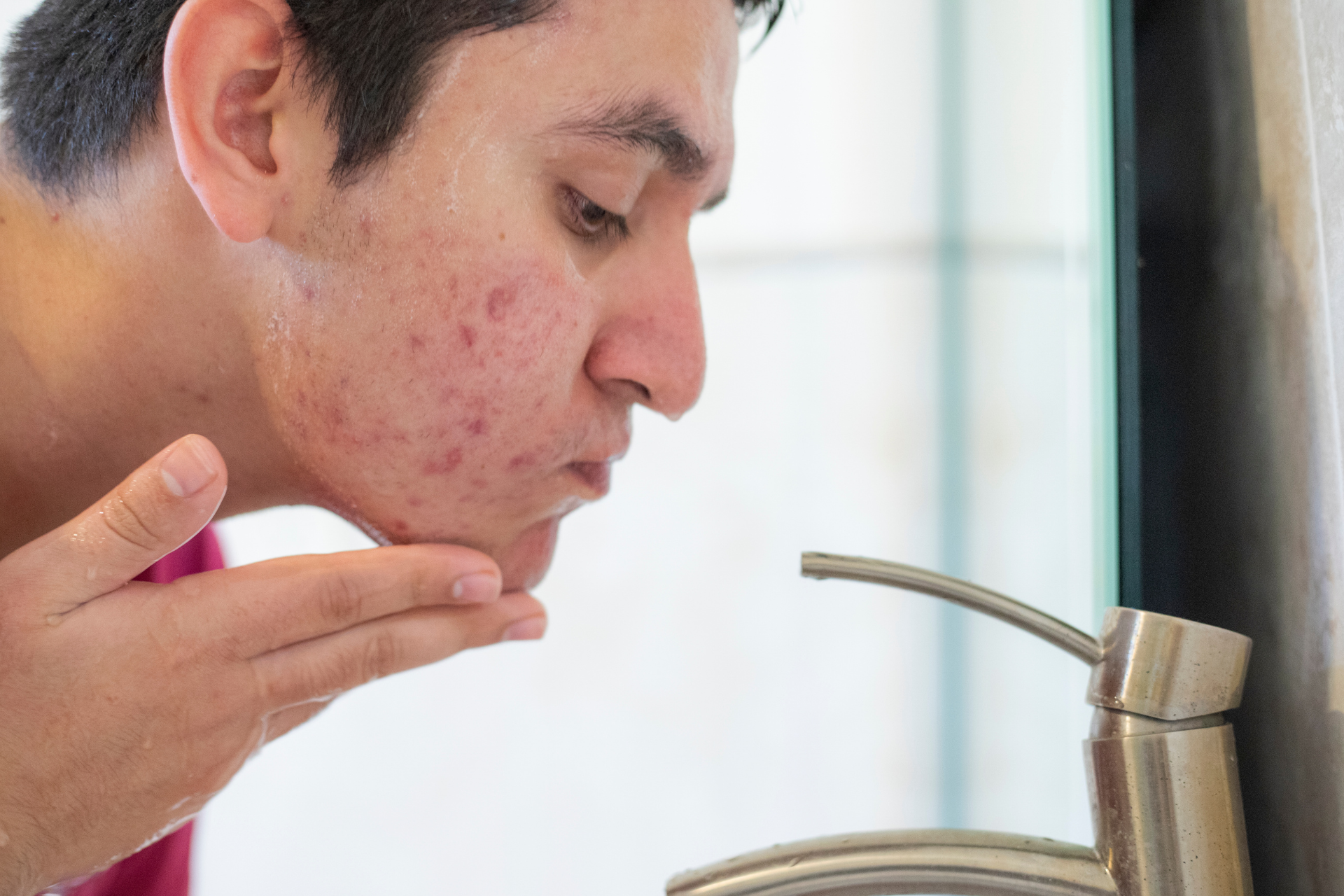 Man with Acne