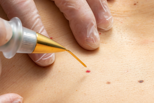 can glutathione remove warts Wart Removal: Safe and Effective Treatments glutathione vs salicylic acid