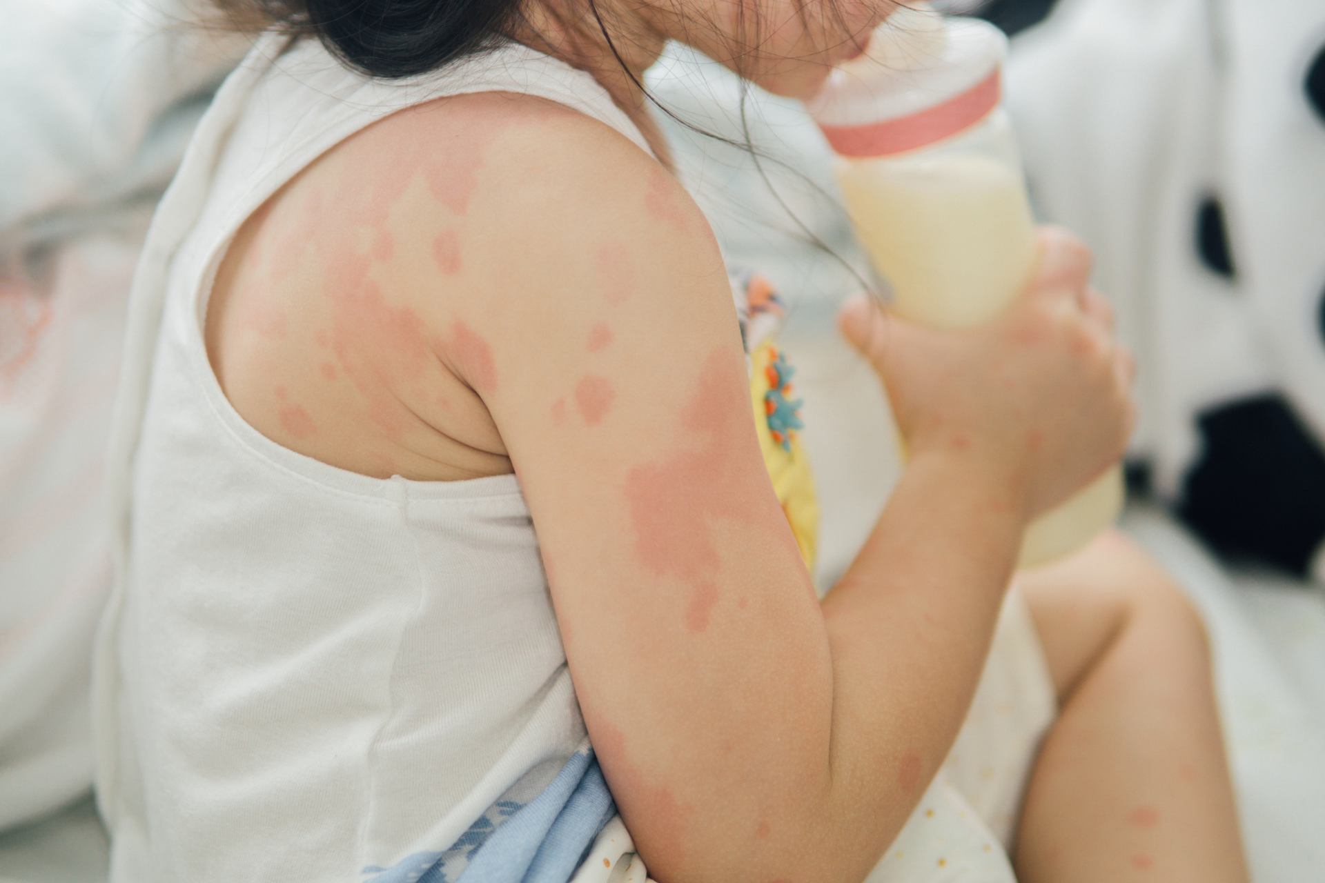 Skin Reaction to Allergy